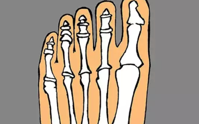 Hallux Valgus_k